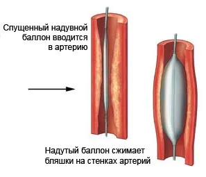Баллонная пластика